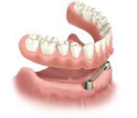 ALTATMtreatment2