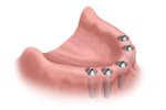 ATMtreatment2