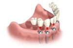 ATMtreatment3