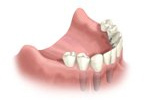 ATMtreatment4